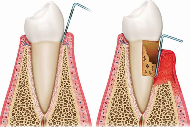 Diente sano vs diente enfermo con sonda