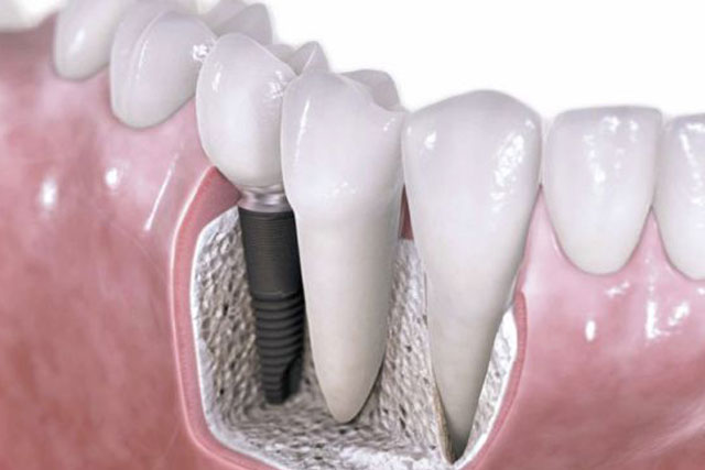 Implantes dentales para el reemplazo de dientes