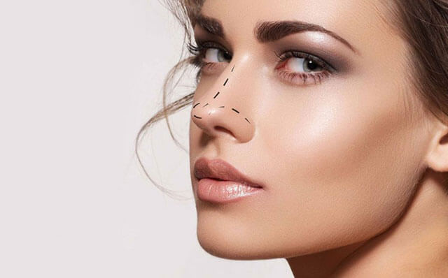 Rinomodelación con ácido hialurónico